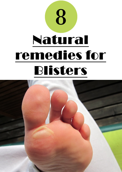 Natural-remedies-for-Blisters